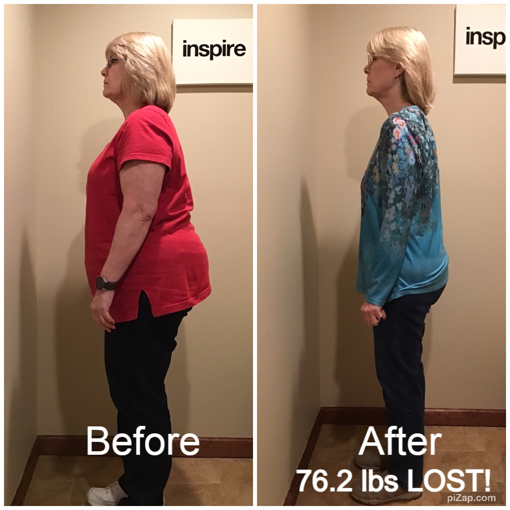 Inspire client HC, lost 76.2 pounds